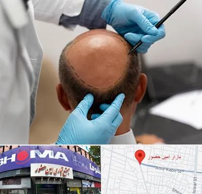 آموزش کاشت مو در امین حضور