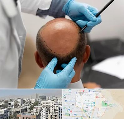 آموزش کاشت مو در منطقه 14 تهران 