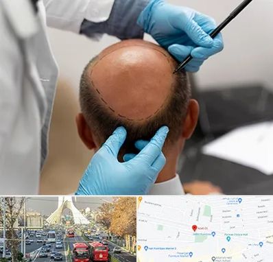 آموزش کاشت مو در خیابان آزادی 