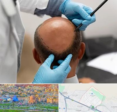 آموزش کاشت مو در رشدیه تبریز