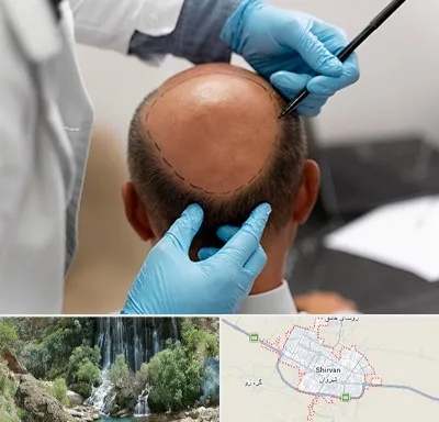 آموزش کاشت مو در شیروان