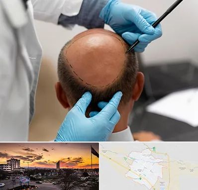 آموزش کاشت مو در قوچان