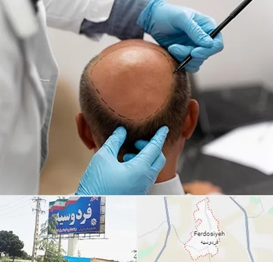 آموزش کاشت مو در فردوسیه شهریار