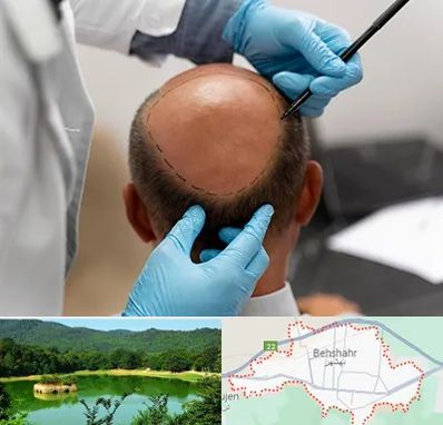 آموزش کاشت مو در بهشهر