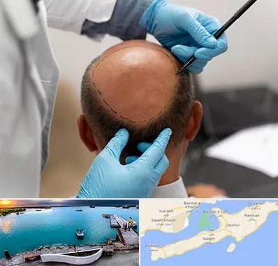 آموزش کاشت مو در قشم