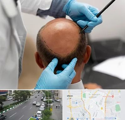 آموزش کاشت مو در ستارخان 