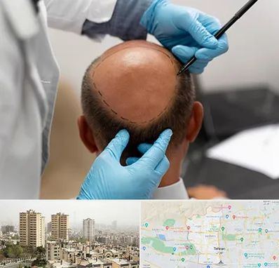 آموزش کاشت مو در منطقه 5 تهران 