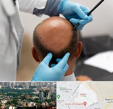 آموزش کاشت مو در عظیمیه کرج 