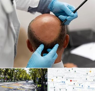 آموزش کاشت مو در میرداماد 