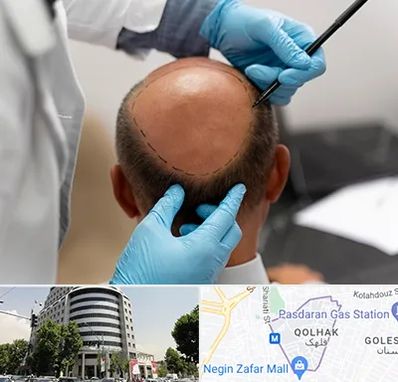 آموزش کاشت مو در قلهک 