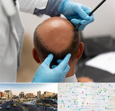 آموزش کاشت مو در منطقه 7 تهران 