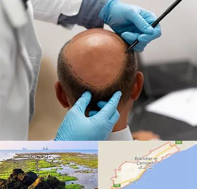 آموزش کاشت مو در بندرلنگه