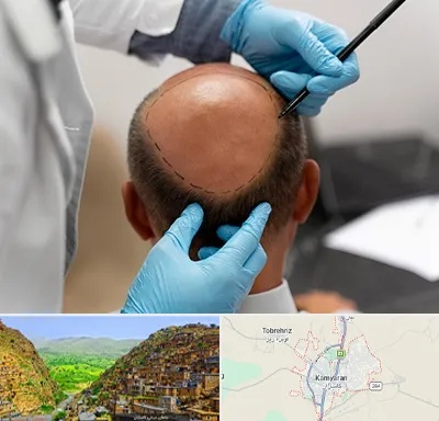آموزش کاشت مو در کامیاران