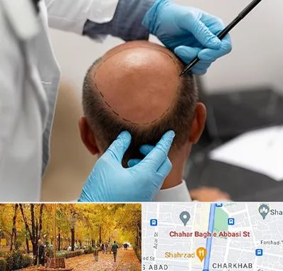 آموزش کاشت مو در چهارباغ اصفهان 