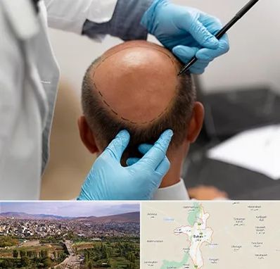 آموزش کاشت مو در بوکان