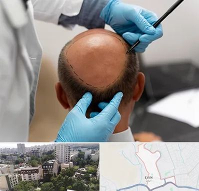 آموزش کاشت مو در اوین