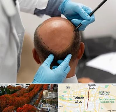 آموزش کاشت مو در ولیعصر 