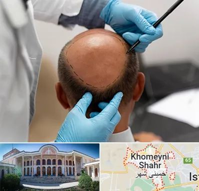 آموزش کاشت مو در خمینی شهر