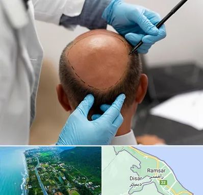آموزش کاشت مو در رامسر