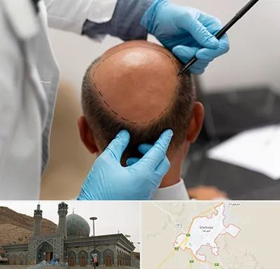 آموزش کاشت مو در شهرضا