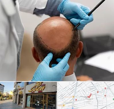 آموزش کاشت مو در عطاران قم