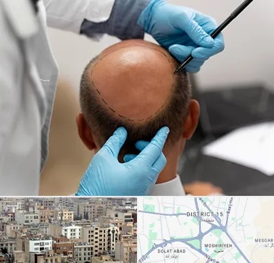 آموزش کاشت مو در جنوب شرق تهران