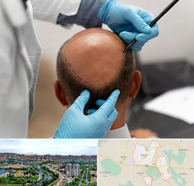 آموزش کاشت مو در شهریار