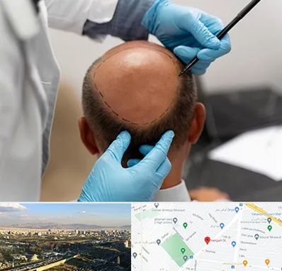 آموزش کاشت مو در هنگام
