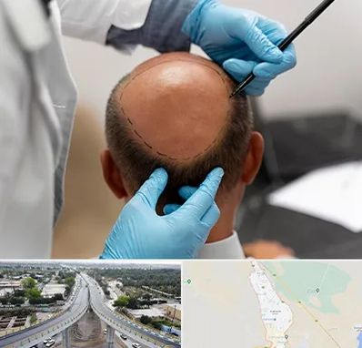 آموزش کاشت مو در اندیمشک