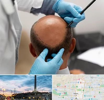 آموزش کاشت مو در منطقه 2 تهران 