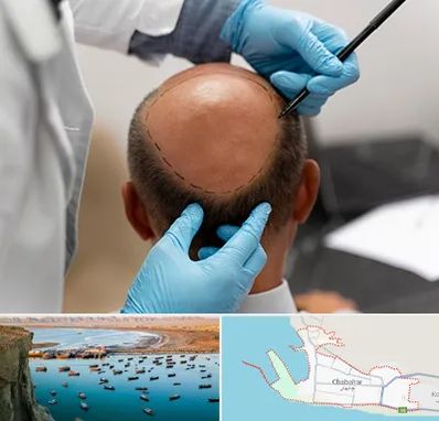 آموزش کاشت مو در چابهار