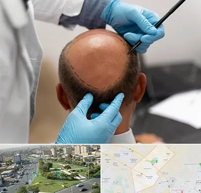 آموزش کاشت مو در کمال شهر کرج 