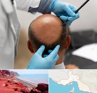 آموزش کاشت مو در هرمزگان