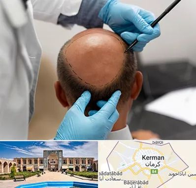 آموزش کاشت مو در کرمان