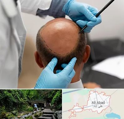 آموزش کاشت مو در علی آباد کتول