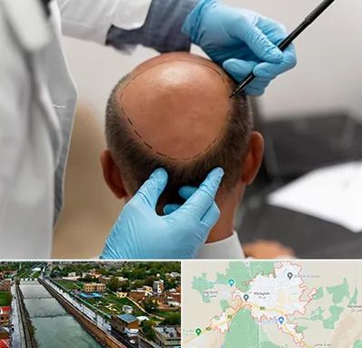 آموزش کاشت مو در مراغه