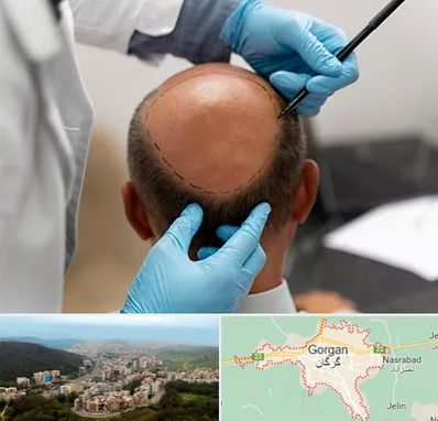 آموزش کاشت مو در گرگان