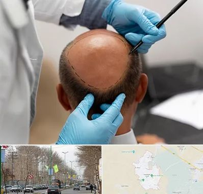 آموزش کاشت مو در نظرآباد کرج 