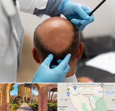 آموزش کاشت مو در شهر ری