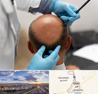 آموزش کاشت مو در قم