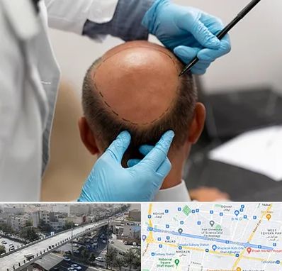 آموزش کاشت مو در فرجام 