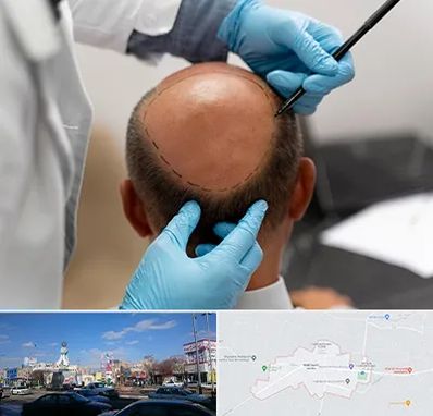 آموزش کاشت مو در ماهدشت کرج 