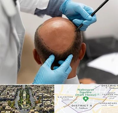 آموزش کاشت مو در نارمک 