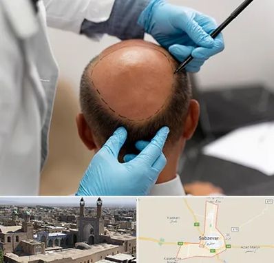 آموزش کاشت مو در سبزوار