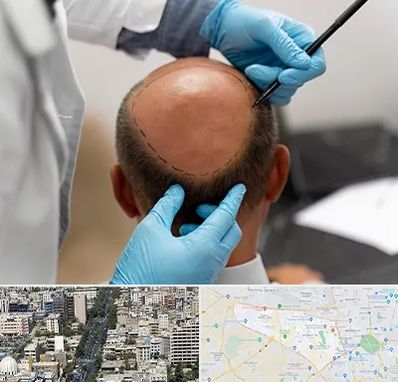 آموزش کاشت مو در منطقه 18 تهران