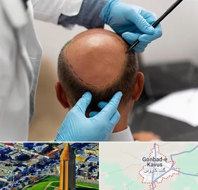 آموزش کاشت مو در گنبد کاووس