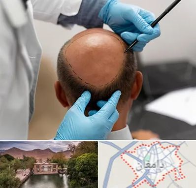 آموزش کاشت مو در دامغان