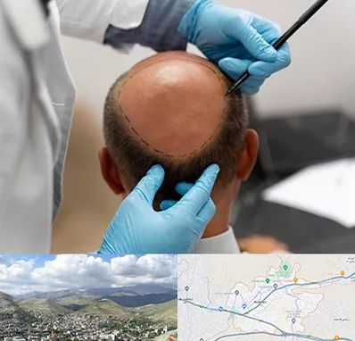 آموزش کاشت مو در رودهن