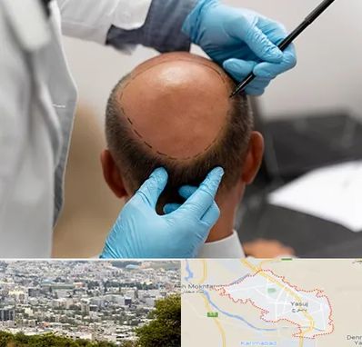 آموزش کاشت مو در یاسوج