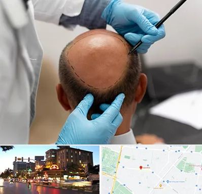 آموزش کاشت مو در بلوار سجاد مشهد 